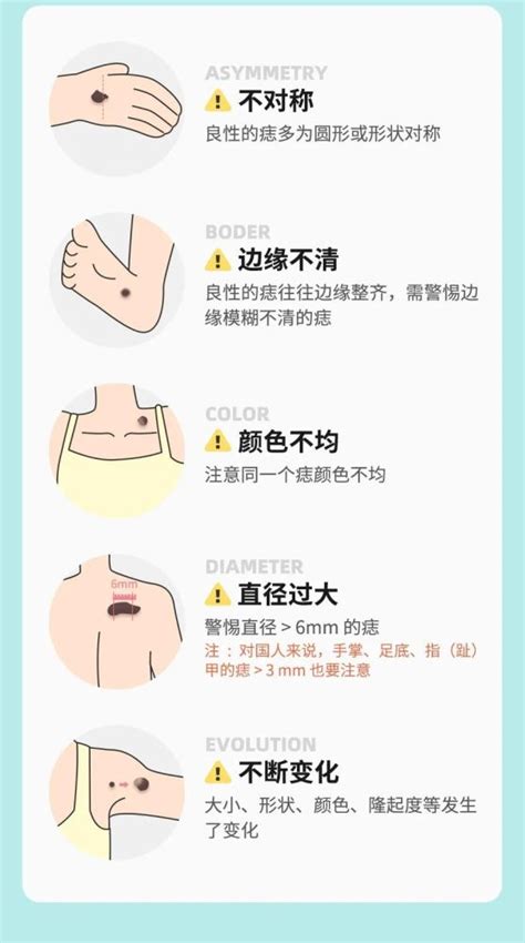 背部很多痣|痣也可能会癌变！长在 3 个地方要注意